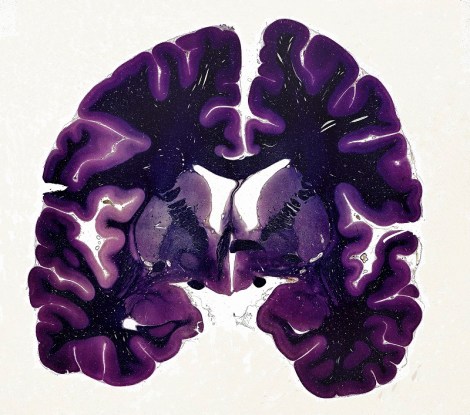B0009564 Human brain, coronal section, LM